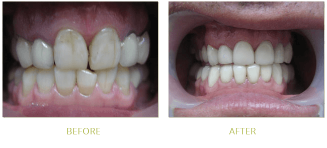 Smile Gallery Before After 02