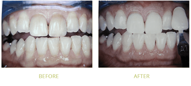 Smile Gallery Before After 04