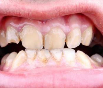 badly decayed gum and teeth