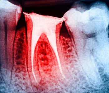 Root canals are treatment for decayed teeth can reduce risk of cancer for patients in Central HK
