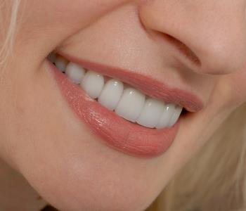 With porcelain veneers, your dentist in Hong Kong achieves natural beauty