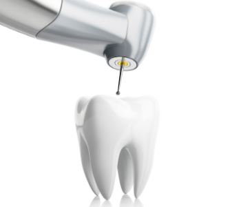 Root canal therapy