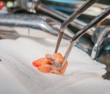 tooth extraction