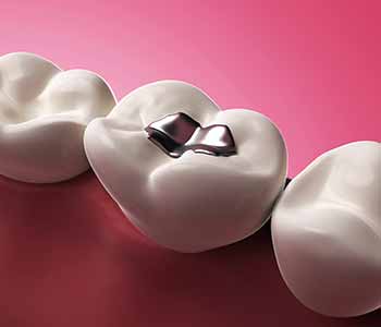 Dr. Titania Tong combines holistic dental approaches and the advanced Mercury Tri-Test service to get an accurate picture of how this toxin has affected you
