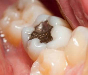 mercury tooth filling