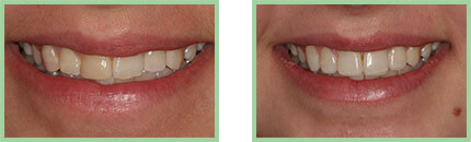 <?php echo $pkSmileGallery;?> - Before After 04