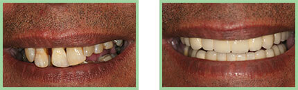 <?php echo $pkSmileGallery;?> - Before After 12
