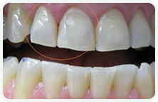 Dentist Oakville - After Teeth Whitening 01