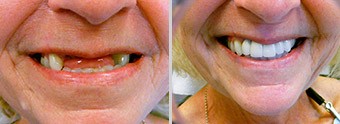 Before, After Image 05, Cincinnati