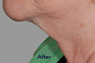 Skin Care Birmingham - Exilis® Laser Treatment  16