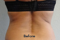Skin Care Birmingham - Exilis® Laser Treatment  17