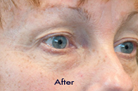 Skin Care Birmingham - Exilis® Laser Treatment  24