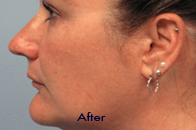 Skin Care Birmingham - Exilis® Laser Treatment  26