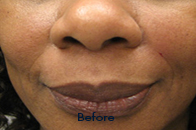 Skin Care Birmingham - Juvederm  01