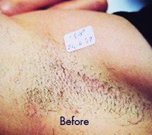 Skin Care Birmingham - Laser Hair Removal 01
