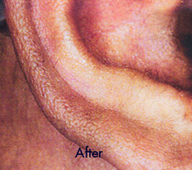 Skin Care Birmingham - Laser Hair Removal 10