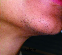 Skin Care Birmingham - Laser Hair Removal 11