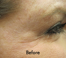 Skin Care Birmingham - Botox / Dysport  21