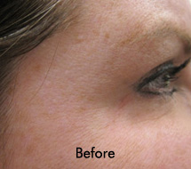 Skin Care Birmingham - Botox / Dysport  22