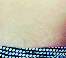 Skin Care Birmingham - Laser Hair Removal 06