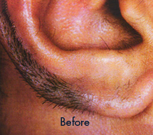 Skin Care Birmingham - Laser Hair Removal 09