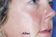 Skin Care Birmingham - SilkPeel1  06