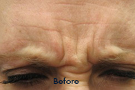 Skin Care Birmingham - Botox / Dysport  01