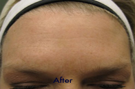 Skin Care Birmingham - Botox / Dysport  12