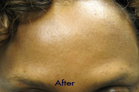 Skin Care Birmingham - Botox / Dysport  16