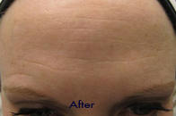 Skin Care Birmingham - Botox / Dysport  02