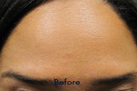 Skin Care Birmingham - Botox / Dysport  20