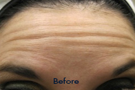 Skin Care Birmingham - Botox / Dysport  03