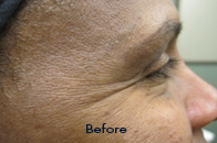 Skin Care Birmingham - Botox / Dysport  05