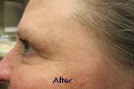 Skin Care Birmingham - Botox / Dysport  08