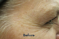 Skin Care Birmingham - Botox / Dysport  09