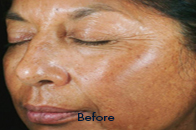 Skin Care Birmingham - Chemical Peel  01