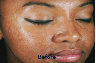 Skin Care Birmingham - Chemical Peel  03