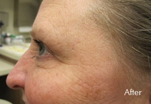 Botox Birmingham - Dysport after Treatment