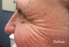 Botox Birmingham -  Dysport before Treatment