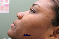 Skin Care Birmingham - Laser Treatment  12