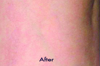 Skin Care Birmingham - Laser Treatment  02