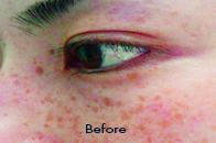 Skin Care Birmingham - Laser Treatment  03
