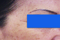 Skin Care Birmingham - Laser Treatment  08