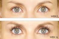 Skin Care Birmingham - Latisse  02