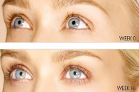 Skin Care Birmingham - Latisse  06