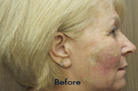 Skin Care Birmingham - Sculptra  01