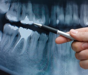 The treatment of root canals in Phoenix