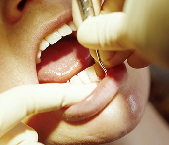 Restore damaged teeth in one visit with dental crowns (caps) in Phoenix