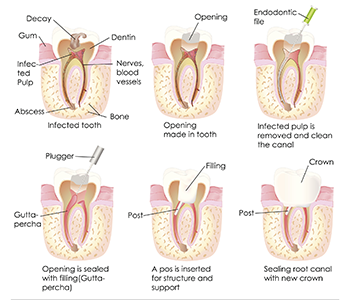 What are Root Canals?