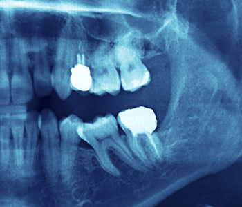 Tooth Aches and Pains